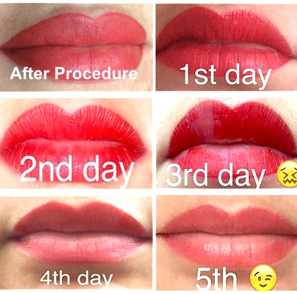 semi permanent lip procedure results