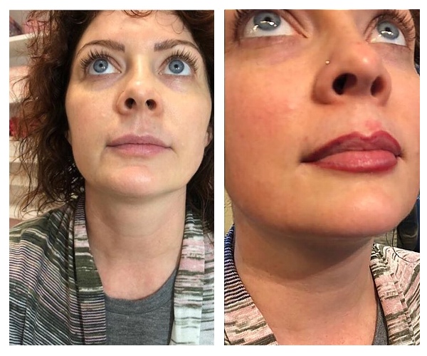 semi permanent lip procedure results